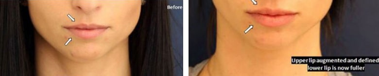 Before and After Image: Fillers & Toxins - front