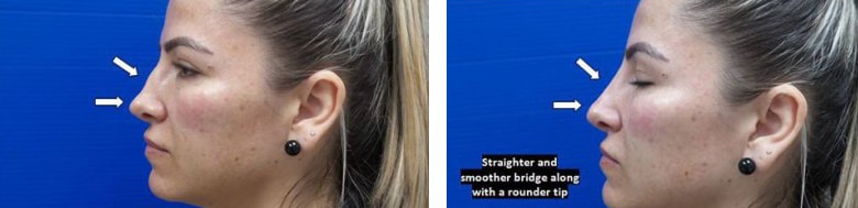 Before and After Image: Fillers & Toxins - left-side