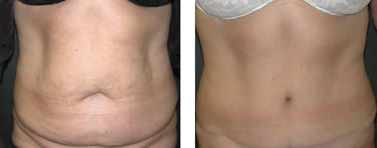 Before and After Image: Abdominoplasty - front