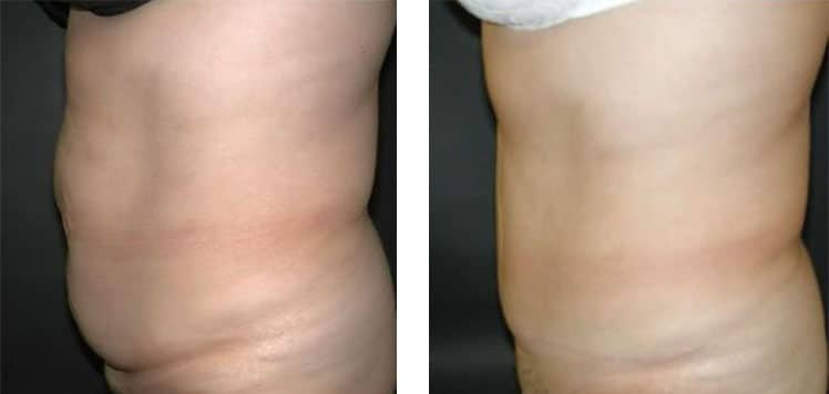 Before and After Image: Abdominoplasty - left-side