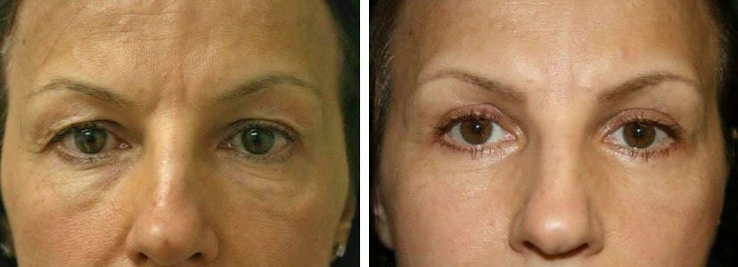 Before and After Image: Blepharoplasty - front