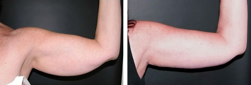 Before and After Image: Brachioplasty - front