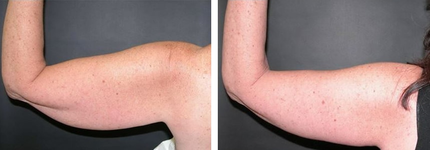 Before and After Image: Brachioplasty - back