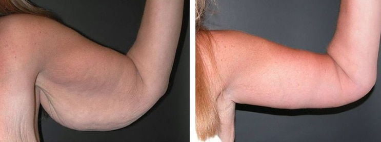 Before and After Image: Brachioplasty - front