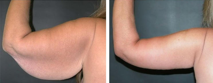 Before and After Image: Brachioplasty - back