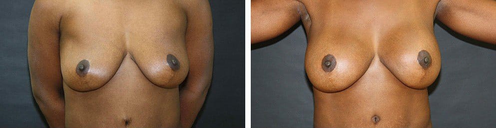 Before and After Image: Breast Augmentation - front