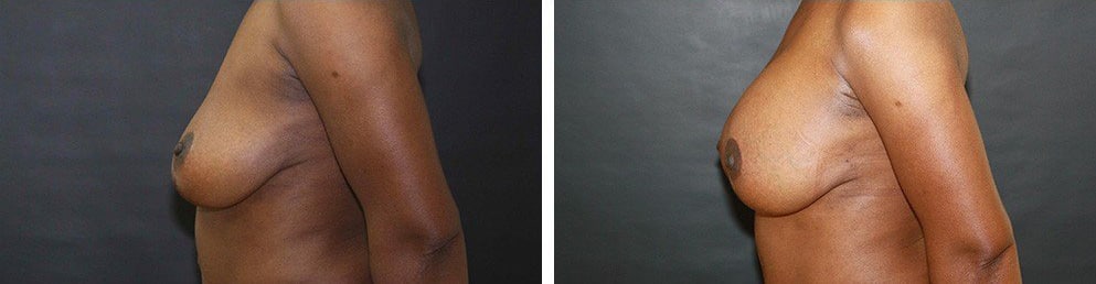 Before and After Image: Breast Augmentation - left-side