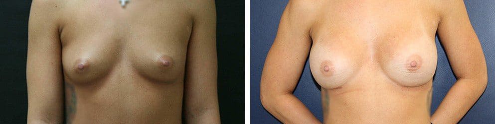 Before and After Image: Breast Augmentation - front