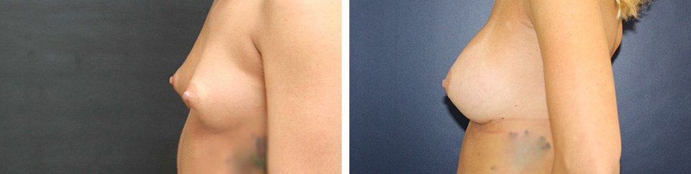 Before and After Image: Breast Augmentation - left-side