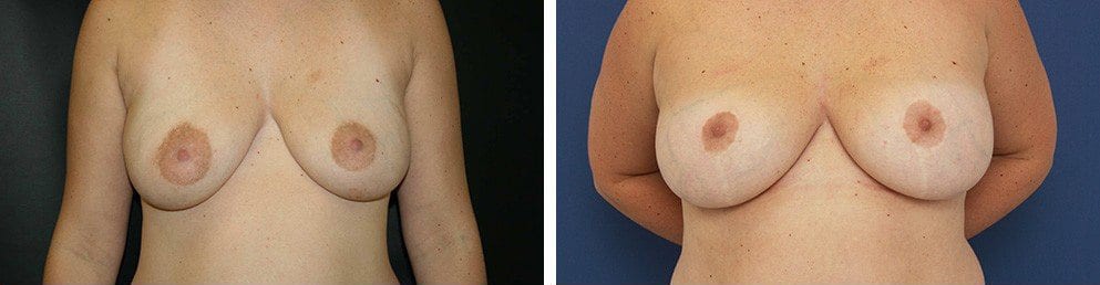 Before and After Image: Breast Augmentation - front