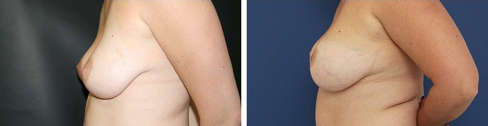 Before and After Image: Breast Augmentation - left-side