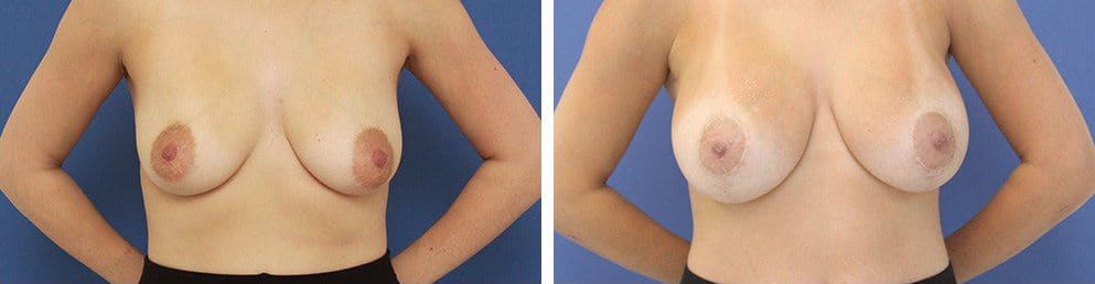 Before and After Image: Breast Augmentation - front