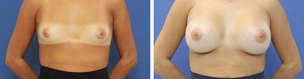 Before and After Image: Breast Augmentation - front