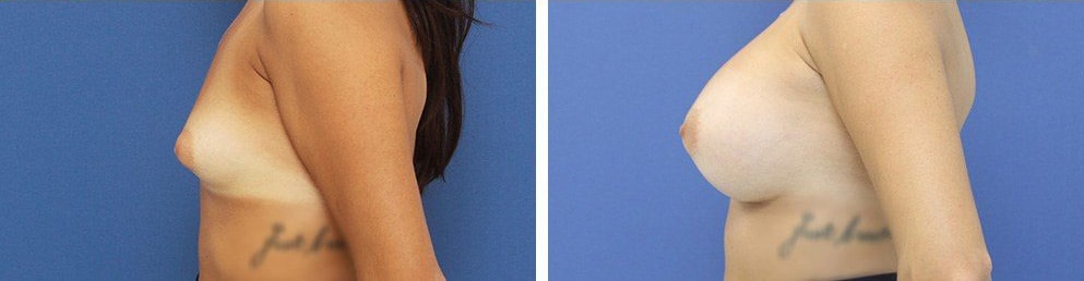 Before and After Image: Breast Augmentation - left-side