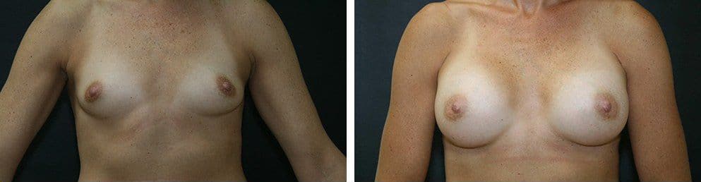 Before and After Image: Breast Augmentation - front