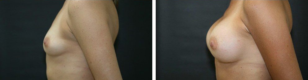 Before and After Image: Breast Augmentation - left-side