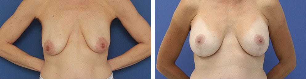 Before and After Image: Breast Augmentation - front
