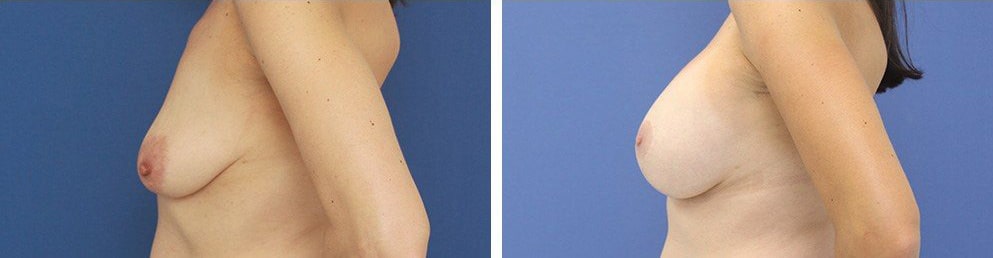 Before and After Image: Breast Augmentation - left-side