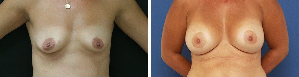 Before and After Image: Breast Augmentation - front