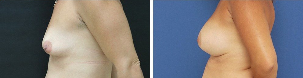 Before and After Image: Breast Augmentation - left-side