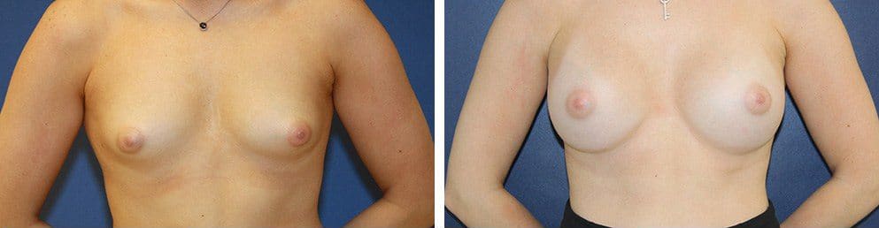 Before and After Image: Breast Augmentation - front