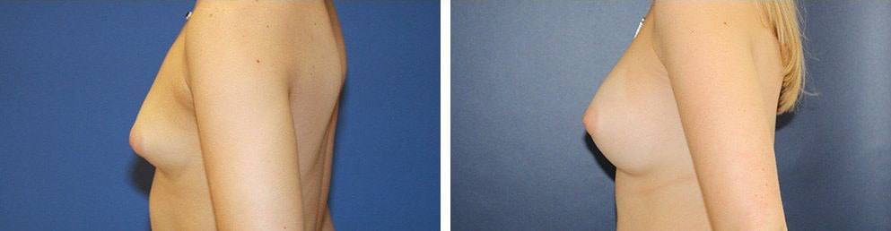 Before and After Image: Breast Augmentation - left-side