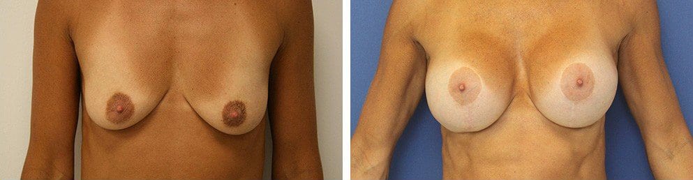 Before and After Image: Breast Augmentation - front