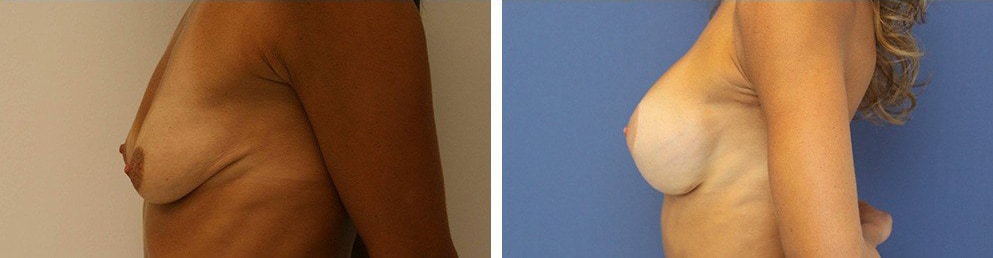 Before and After Image: Breast Augmentation - left-side