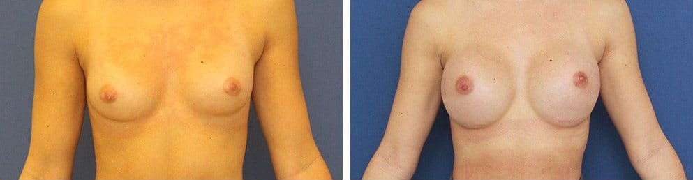 Before and After Image: Breast Augmentation - front