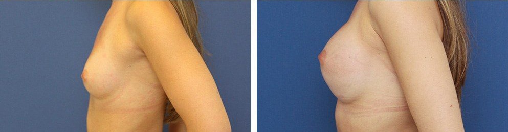 Before and After Image: Breast Augmentation - left-side