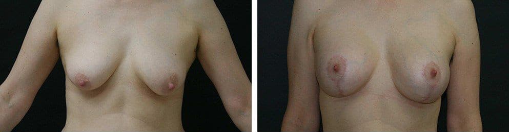 Before and After Image: Breast Augmentation - front