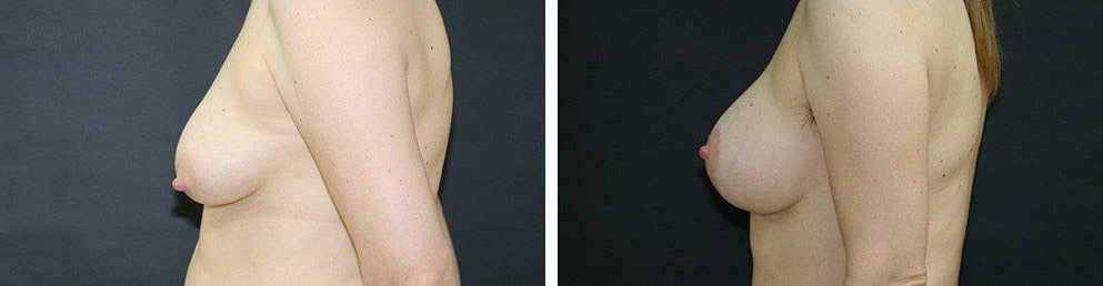 Before and After Image: Breast Augmentation - left-side