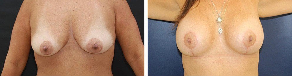Before and After Image: Breast Augmentation - front