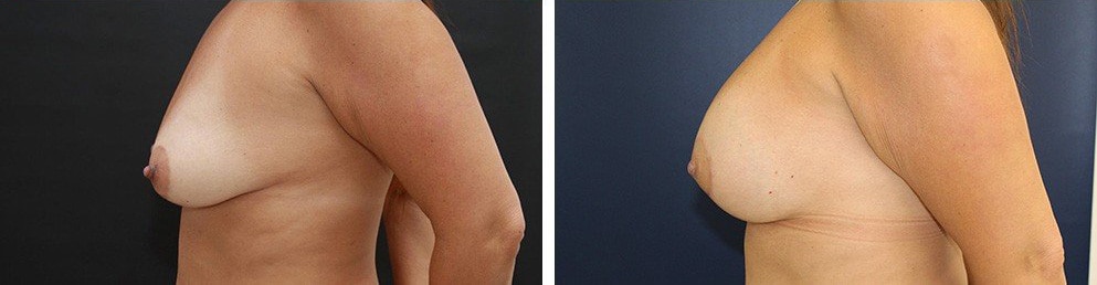 Before and After Image: Breast Augmentation - left-side
