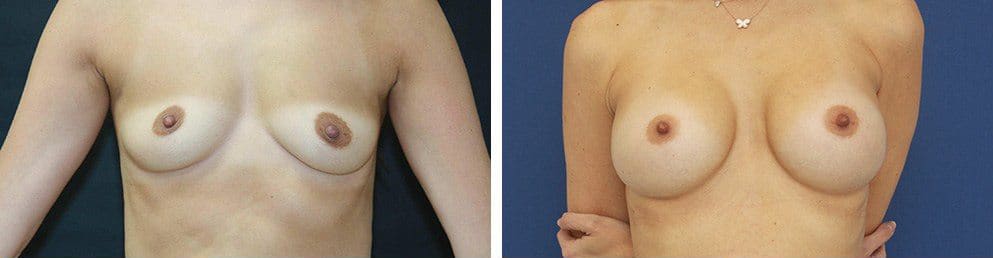 Before and After Image: Breast Augmentation - front