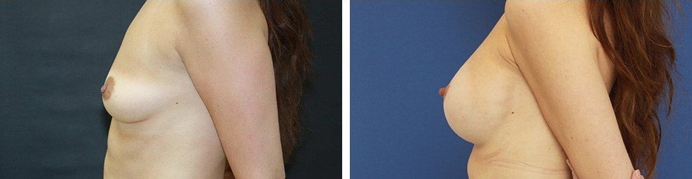 Before and After Image: Breast Augmentation - left-side