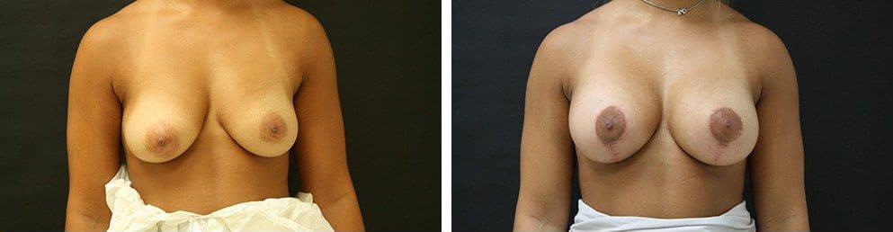 Before and After Image: Breast Augmentation - front