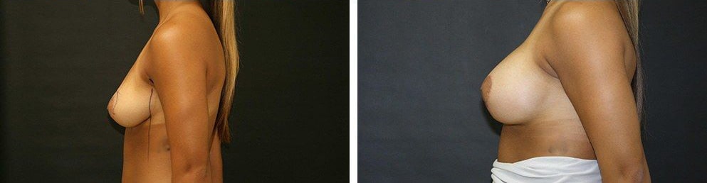 Before and After Image: Breast Augmentation - left-side