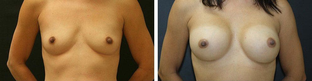 Before and After Image: Breast Augmentation - front