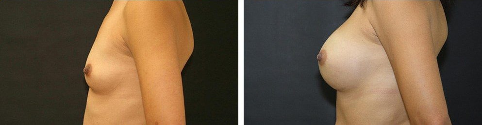Before and After Image: Breast Augmentation - left-side
