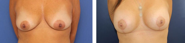 Before and After Image: Breast Augmentation with Mastopexy - front