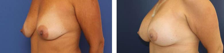 Before and After Image: Breast Augmentation with Mastopexy - left-front-oblique