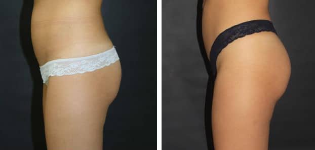 Before and After Image: Butt Augmentation - left-side
