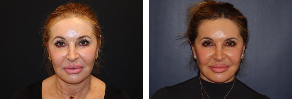 Before and After Image: Facelift - front