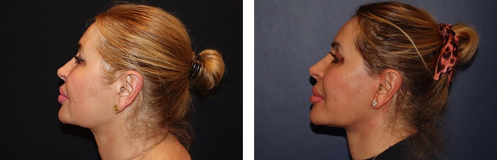 Before and After Image: Facelift - left-side
