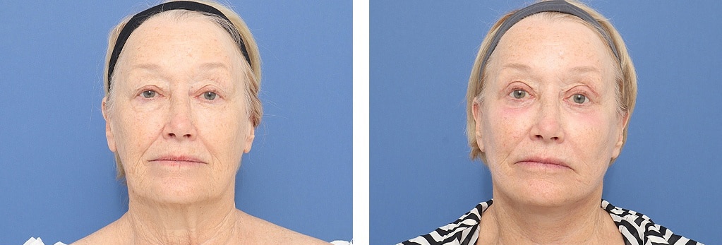 Before and After Image: Facelift - front