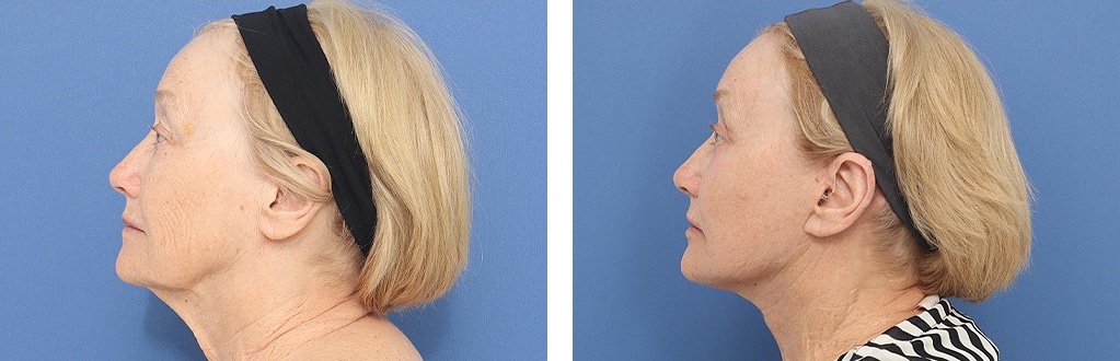 Before and After Image: Facelift - left-side