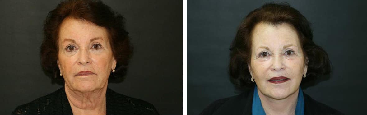 Before and After Image: Facelift - front