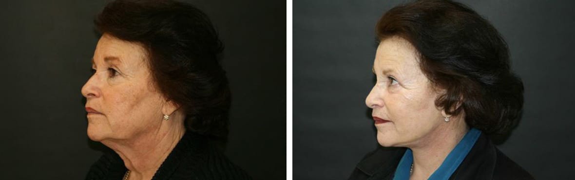 Before and After Image: Facelift - left-side