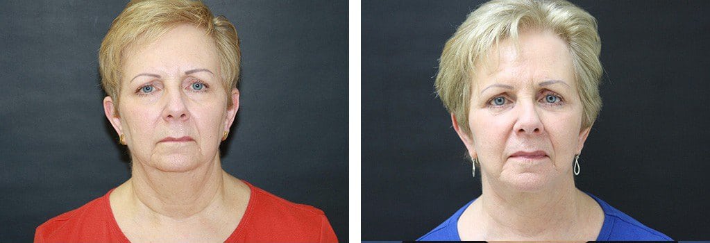 Before and After Image: Facelift - front